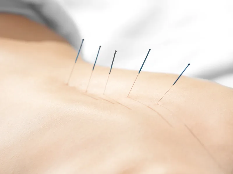 Acupuncture at Next Level Chiropractic & Wellness in Caro