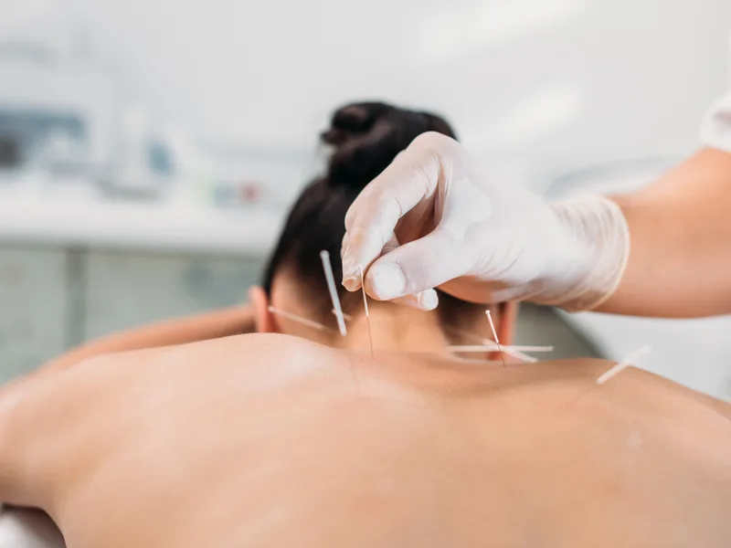 Dry Needling at Next Level Chiropractic & Wellness in Caro